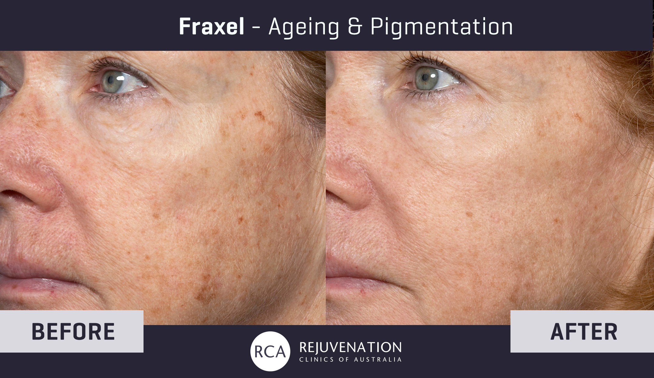 Fraxel-Before-After