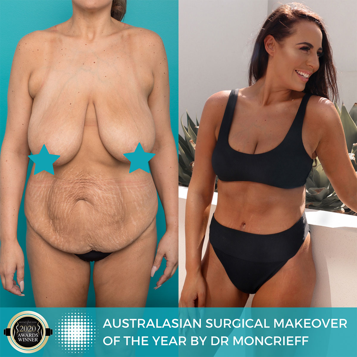 AustralAsian Surgical Makeover of the Year by Dr Moncrieff