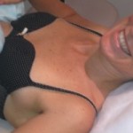My CoolSculpting Experience - Clinic Aesthetic in Brisbane