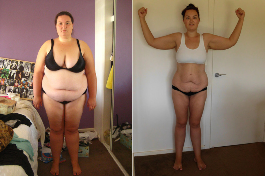 Jess' Story - My Body Lift, Breast Lift & Augmentation After Losing 70 kg