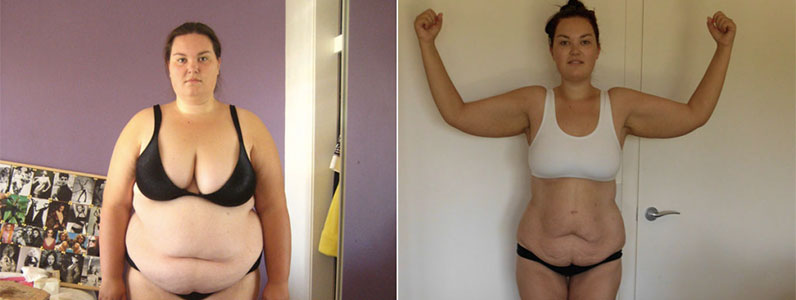 Jess’ Story – My Body Lift, Breast Lift & Augmentation After Losing 70 kg