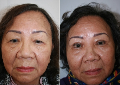 Asian Blepharoplasty- Before & After