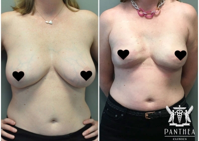 Breast Reconstruction by Dr Ross Farhadieh