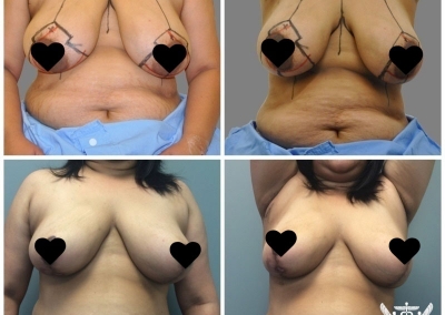 Breast Reduction by Dr Ross Farhadieh