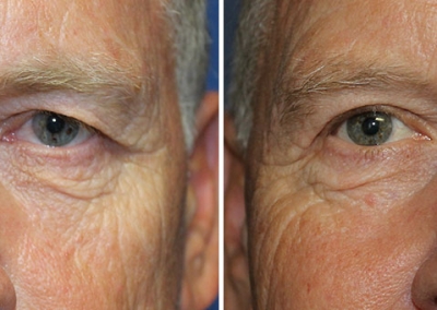 Blepharoplasty by Dr Damian Marucci