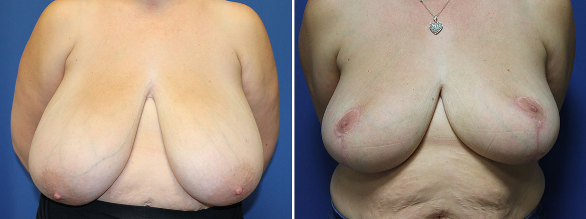 Evaluation Of Capsular Contracture Following Immediate Prepectoral Versus Subpectoral Direct