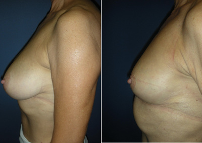 Breast Reduction Photo Gallery - BR Patient 1 - side on Plastic Surgery Hub