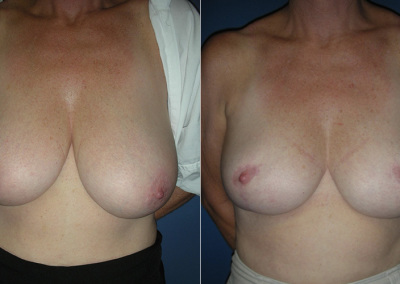 Breast Reduction Photo Gallery - BR Patient 2 - front on Plastic Surgery Hub