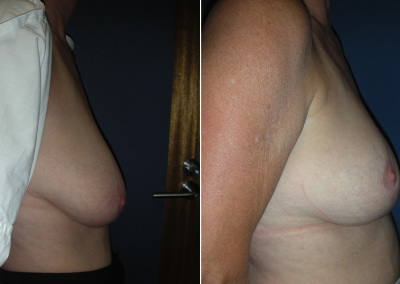Breast Reduction Photo Gallery - BR Patient 2 - side on Plastic Surgery Hub