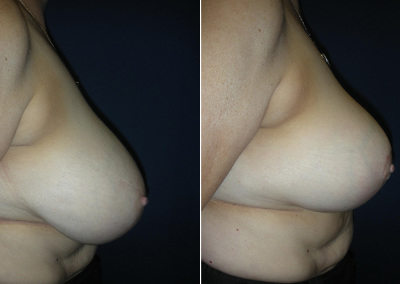 Breast Reduction Photo Gallery - BR Patient 3 - side on Plastic Surgery Hub