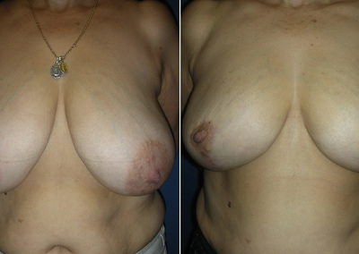 Breast Reduction Photo Gallery - BR Patient 4 - front on Plastic Surgery Hub