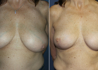 Breast Reduction Photo Gallery - BR Patient 5 - front on Plastic Surgery Hub