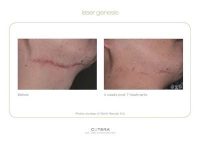 Laser Genesis - Before & After