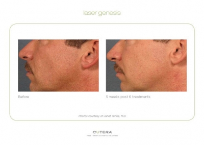 Laser Genesis - Before & After