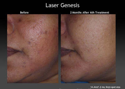 Laser Genesis Treatment