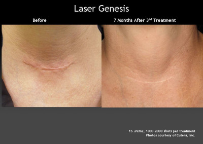 Laser Genesis Treatment