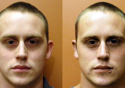 Dr Damian Marucci - Patient 6 Otoplasty Man Before and After Photo - PSH Plastic Surgery Hub