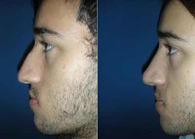 Dr Damian Marucci, Sydney NSW Rhinoplasty Before and After Image