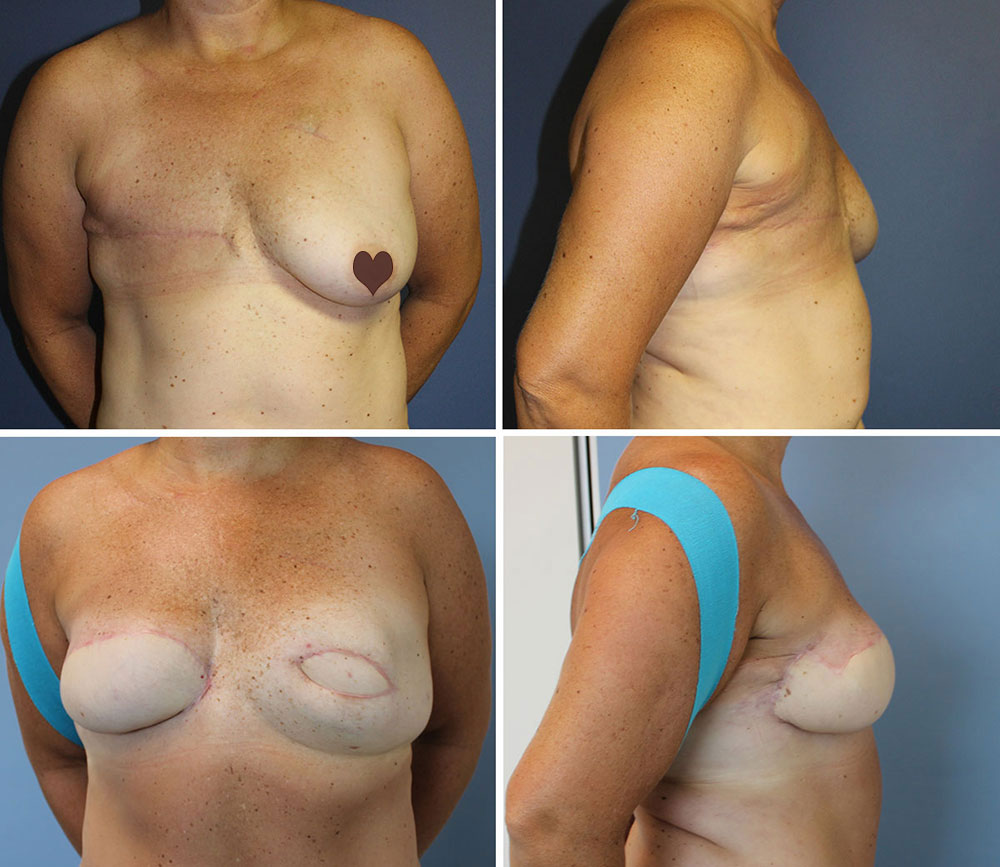 Tina's Bilateral Breast Reconstruction