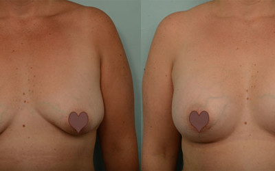 Julie’s Breast Surgery Patient Story with Dr Briggs – get rid of my saggy boobs!