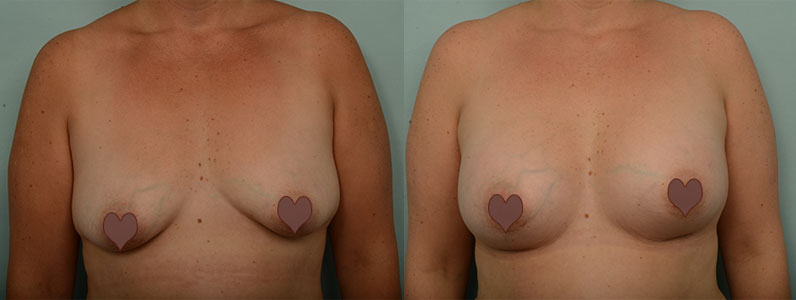 Julie’s Breast Surgery Patient Story with Dr Briggs – get rid of my saggy boobs!