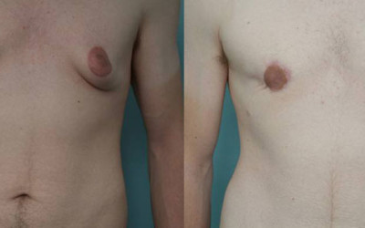 Luke’s Gynecomastia Patient Story with Dr Briggs – Up Close and Personal