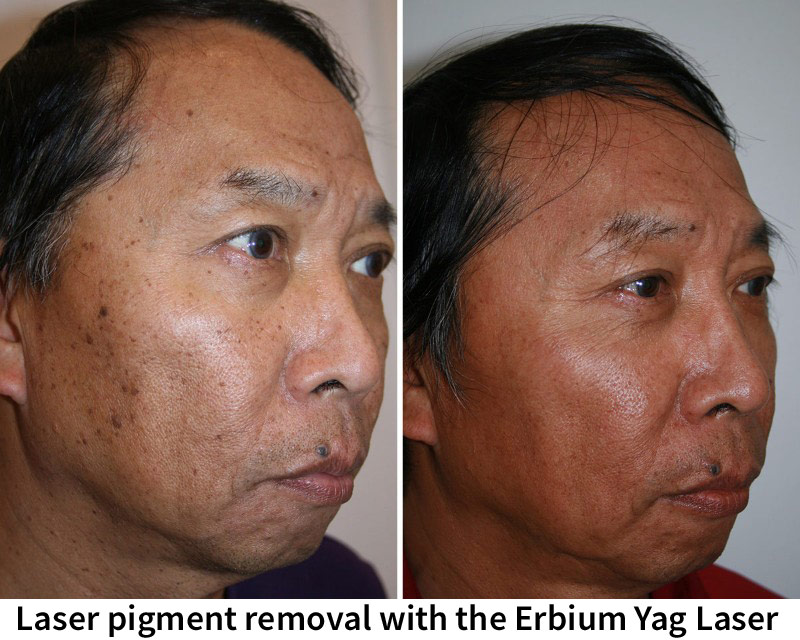Laser pigment removal with the Erbium Yag Laser