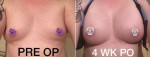 Amelia's Breast Augmentation