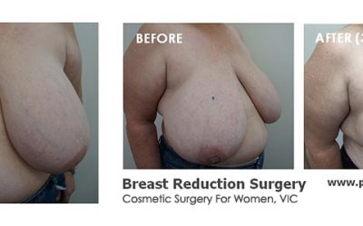 Karen’s Breast Reduction Patient Story with Coco Ruby Plastic Surgery