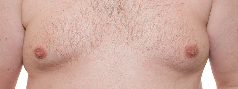 Gynecomastia Causes and Options for Male Breast Reduction