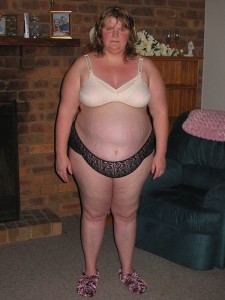 Sheryl Before Weightloss - abdominoplasty patient story
