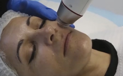 Dr Laniewski’s ‘My Face Clinic’ in Bella Vista showcasing the INFINI Laser