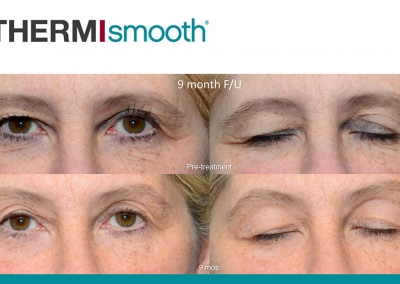 Thermi RF - Before & After