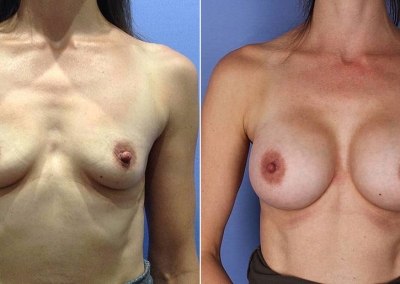 Dr Anh - Breast Augmentation - Before & After