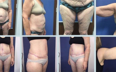 Jo’s  Body Lift Patient Story with Dr Mark Hanikeri – Excess Skin Reduction after losing 50kg