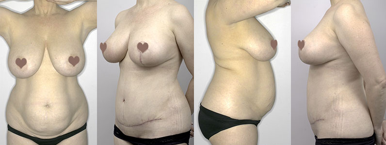 The ins and outs of Angela’s Breast Reduction and Tummy Tuck with Dr Justin Perron, Brisbane