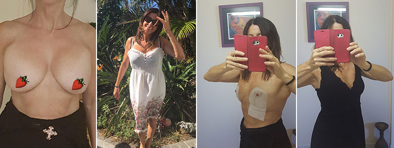 Why I removed my breast implants after 27 years
