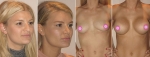 Chloe's Breast Augmentation and Rhinoplasty - new nose and breast
