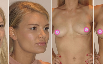 Chloe’s New Nose and Breasts with Dr Jeremy Hunt