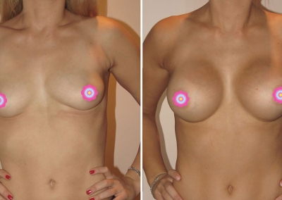Chloe's Breast Augmentation - Before & After - new nose and breast