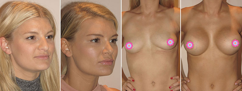 Chloe’s New Nose and Breasts with Dr Jeremy Hunt