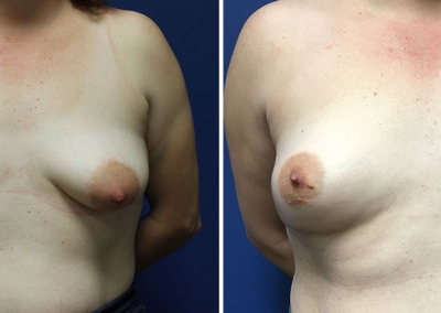 Breast Asymmetry Correction by Dr Damian Marucci