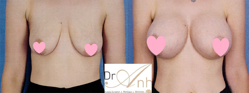 My Breast Augmentation Journey with Dr Anh in Perth