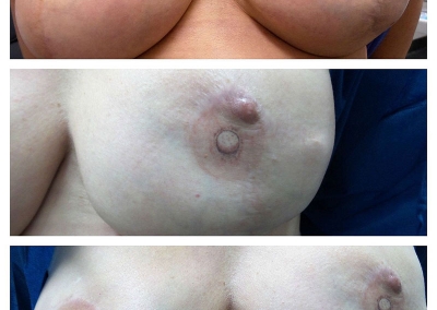 Nipple areola tattooing