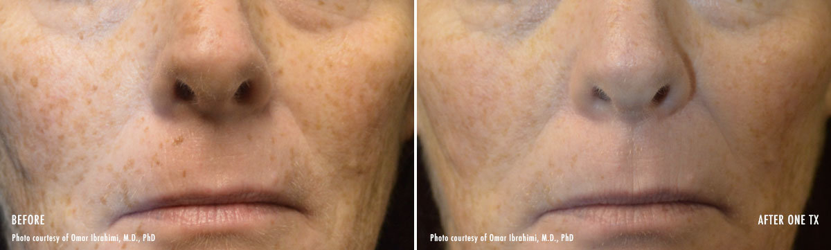 PICO Genesis Laser Skin Rejuvenation