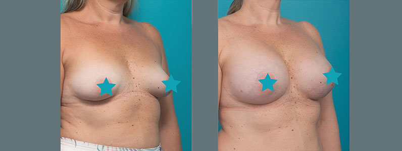 Better Breast Fat Transfer Results with the AdipSculpt