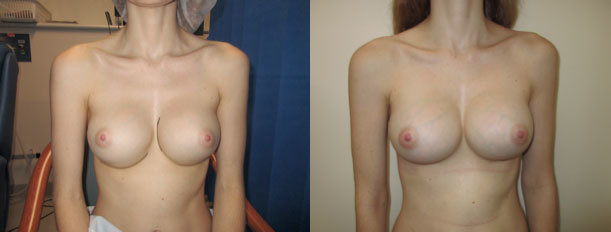 Corrective Breast Surgery