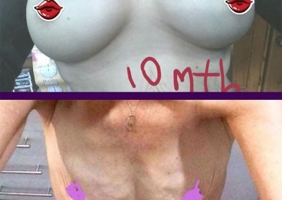 Breast Augmentation by Dr James Gaffield