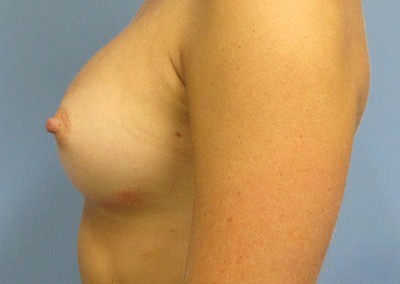 Breast Augmentation by Dr Rohit Kumar