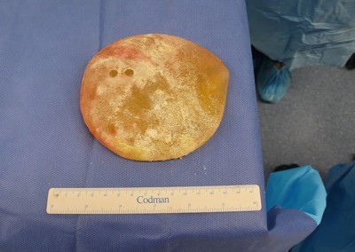 Breast implant infection